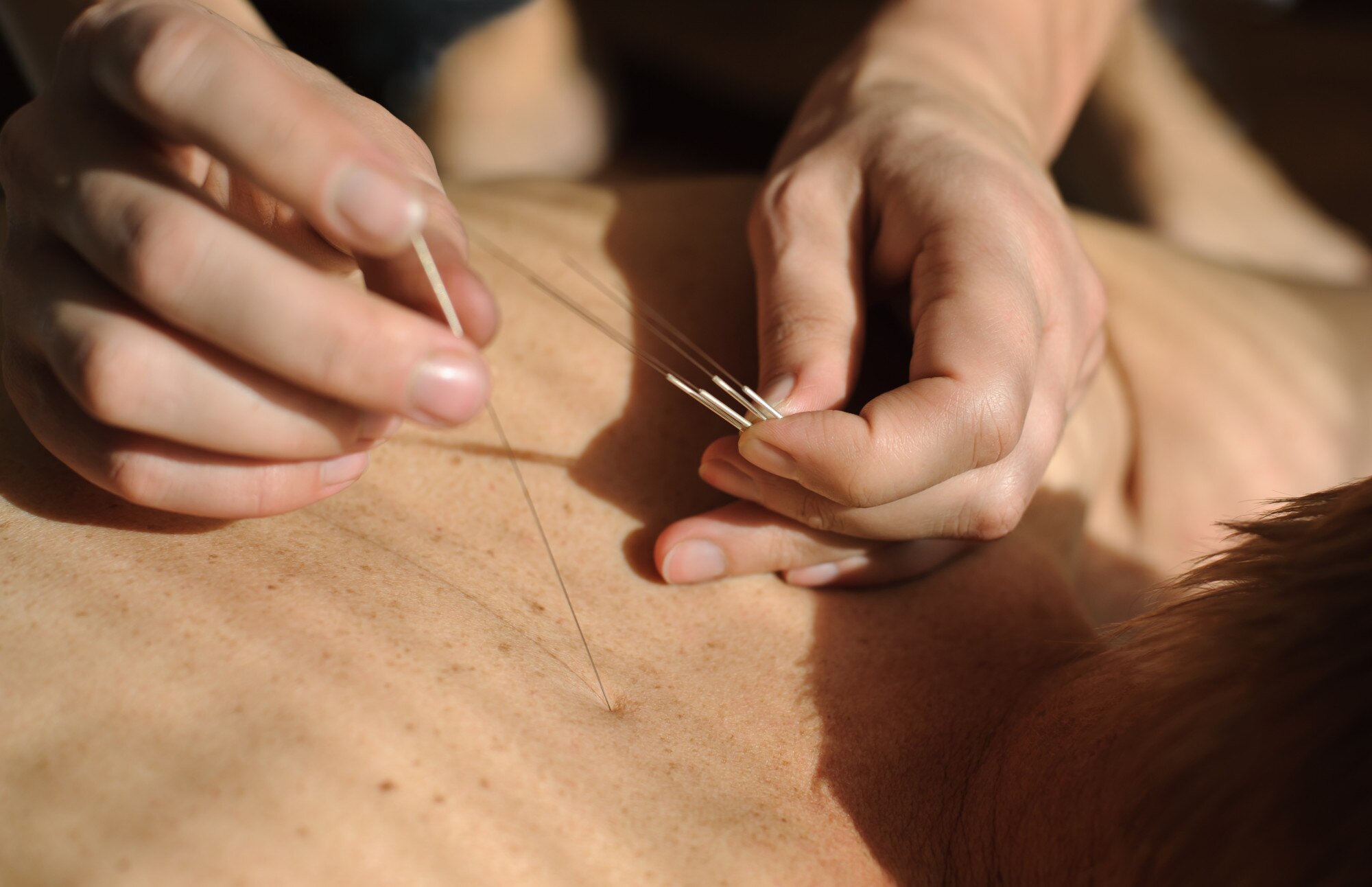 The science of combining acupuncture and massage for holistic pain relief at home